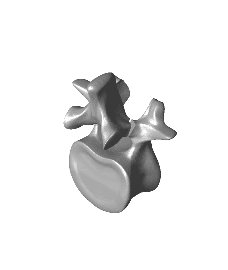 Pars Fracture Spondylolysis 3d model