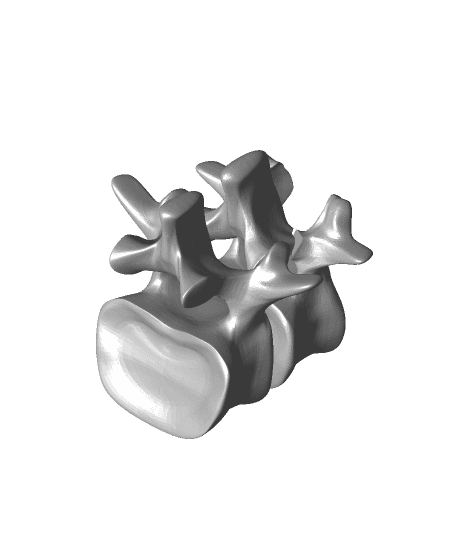 Spondylolysis unilateral teaching example 3d model