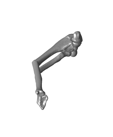 Both bone malunion sag 50 degrees.stl 3d model