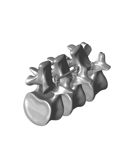 Spondy double decker pars pedicle deluxe package  models.stl 3d model