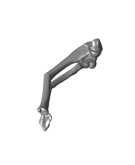 Both bone malunion sag 40 degrees.stl 3d model