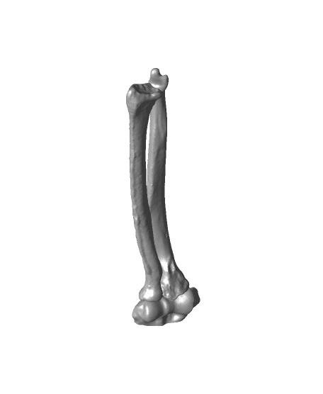 Radius and ulna shaft coronal malunions  3d model