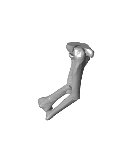 Malunion 40 deree radial coronal.stl 3d model